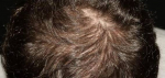 PRP For Thinning Hair - Case #1 After